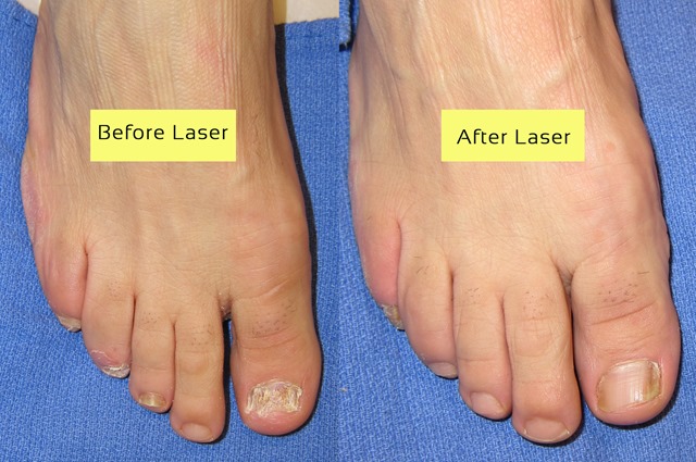 Before And After Laser Toenail Fungus Treatment Archives Toenail 